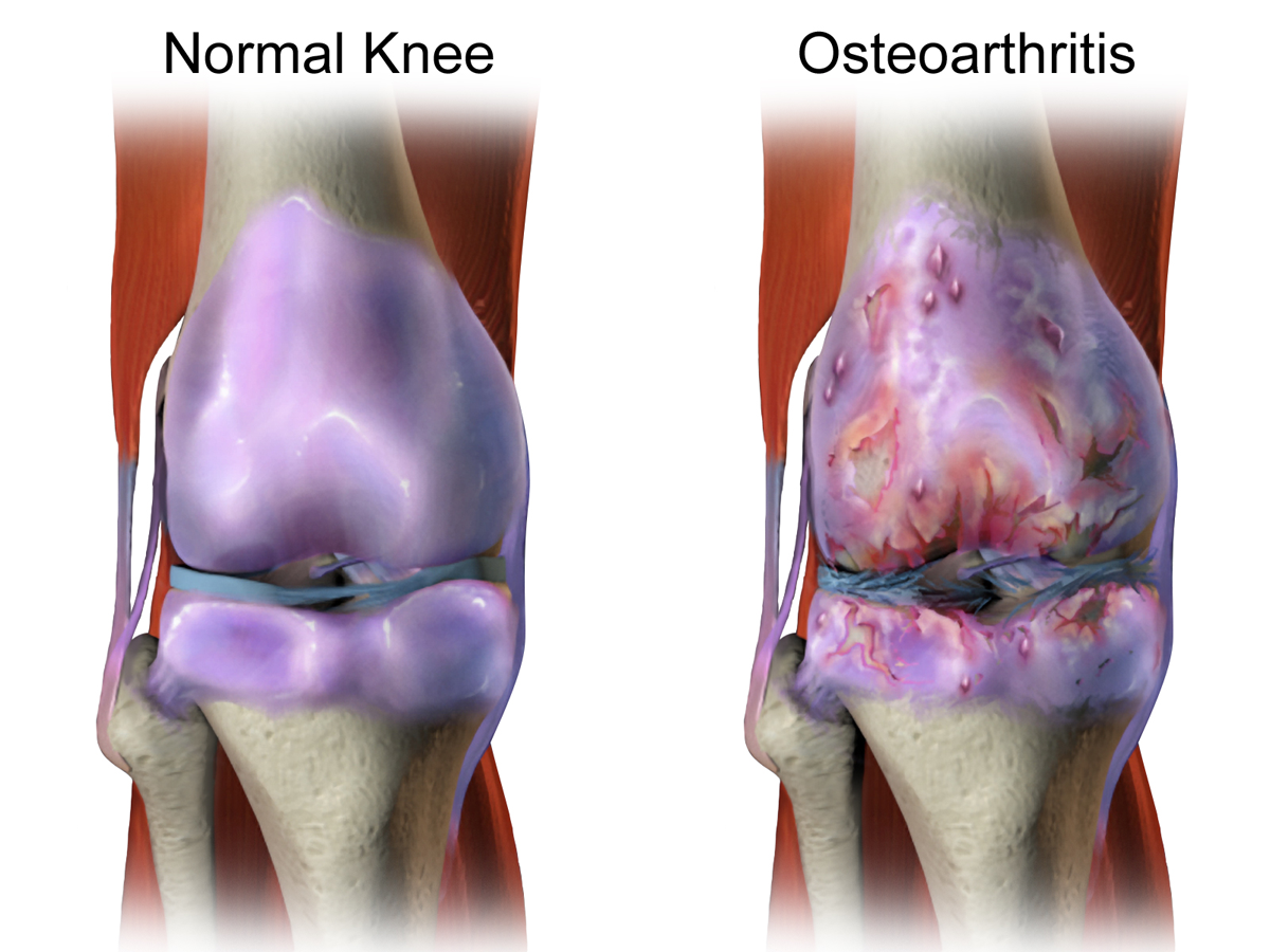 Normal vs Osteoarthritis.